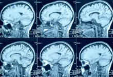 Hematoma subdural crônico: o perigo silencioso das quedas em idosos