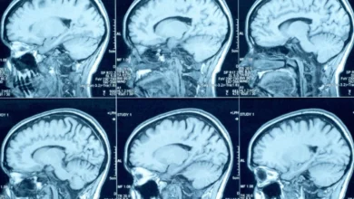 Hematoma subdural crônico: o perigo silencioso das quedas em idosos