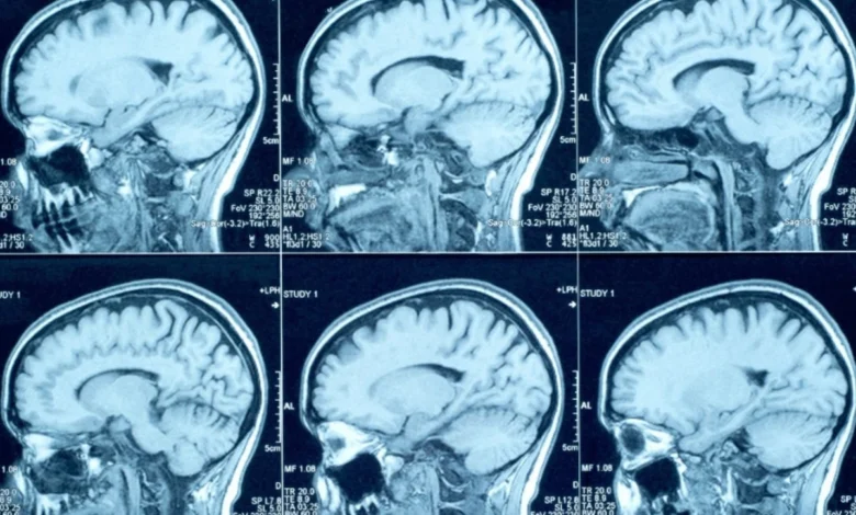 Hematoma subdural crônico: o perigo silencioso das quedas em idosos