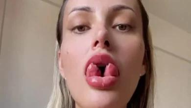 Bifurcação na língua de Andressa Urach será revertida após incidente