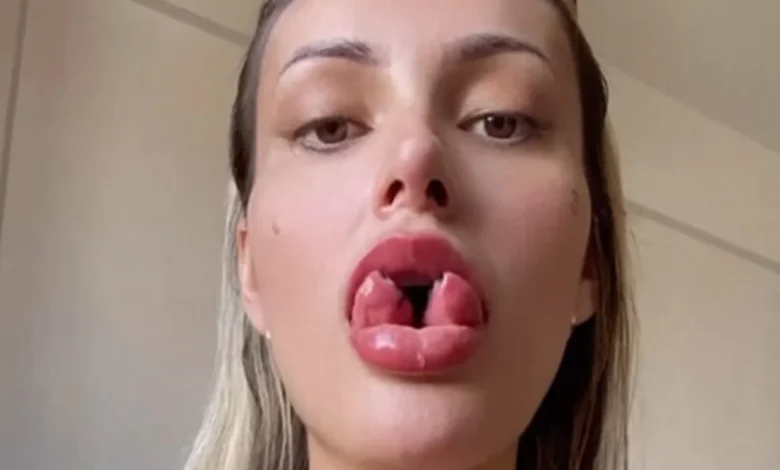 Bifurcação na língua de Andressa Urach será revertida após incidente
