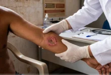 Cientistas da USP desenvolvem nova estratégia molecular contra a leishmaniose cutânea