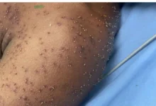 Morador surdo é socorrido inconsciente depois de ataque de abelhas em Itapuranga