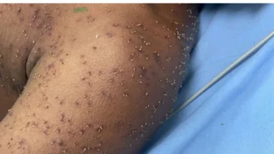 Morador surdo é socorrido inconsciente depois de ataque de abelhas em Itapuranga