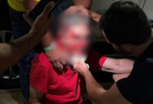 Pastor espancado após usar camiseta vermelha aguarda cirurgia no nariz