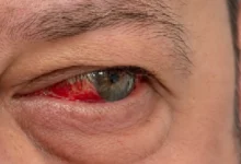 Retinopatia diabética ameaça mais de 250 mil goianos e exige prevenção